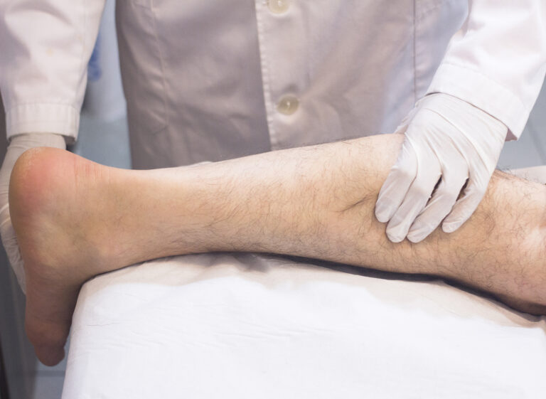 Πότε χρειάζεται χειρουργείο για κιρσούς;