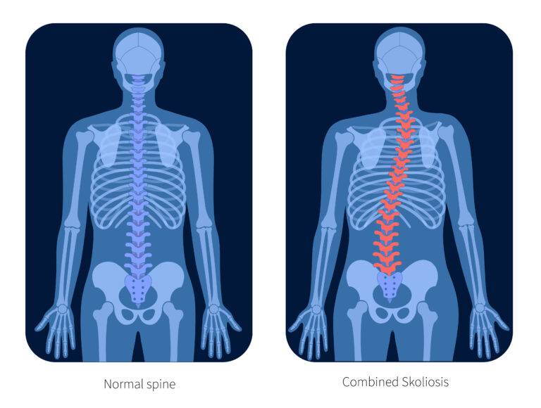 κηδεμόνας σκολίωσης
