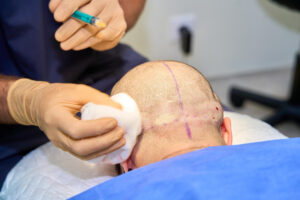 hair transplant in Greece