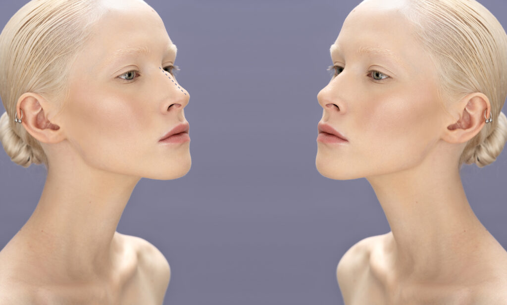 Rhinoplasty Before and After