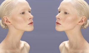 Rhinoplasty Before and After