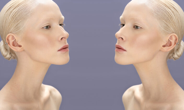 Rhinoplasty Before and After