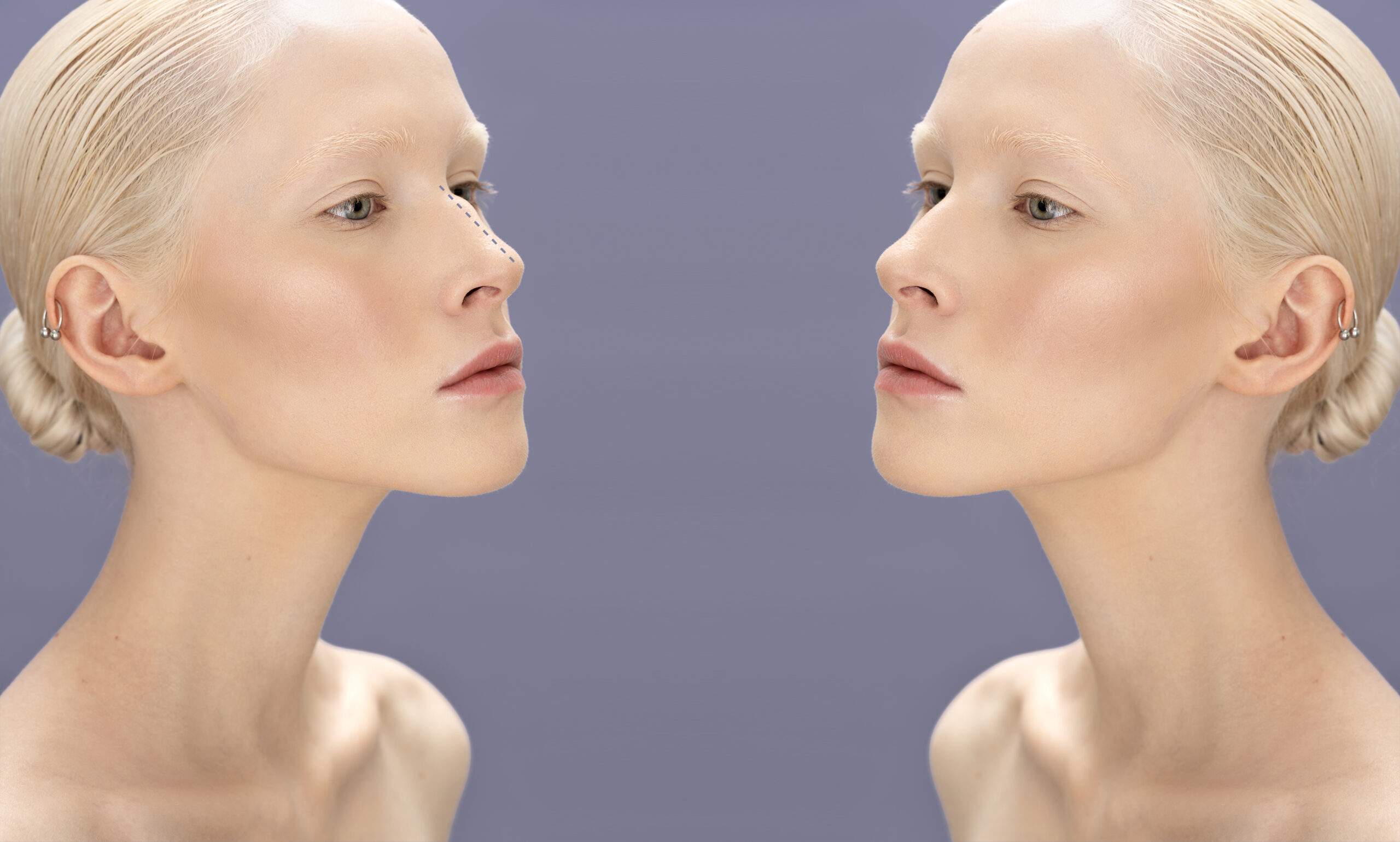 Rhinoplasty Before and After